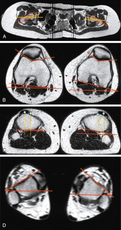 FIG 35-4, A patient's lower limb rotational magnetic resonance imaging profile. A and B, The femoral anteversion for the right knee was 16 degrees on the left and 3 degrees on the right. B and C, The knee version was 3 degrees on the right and 0 degrees on the left. The tibial tubercle/trochlear groove was 14 mm on the right and 12 mm on the left. C and D, External tibial torsion was 30 degrees on the right and 33 degrees on the left. An increased signal alternation is shown for the lateral patellar facet, which is related to the patient's primary abnormality of a bilateral external tibial torsion.