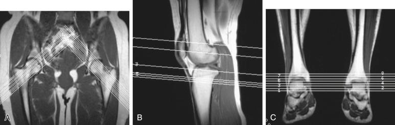 FIG 35-5, T1 Magnetic resonance imaging images obtained at the hip ( A ), knee ( B ), and ankle ( C ). This allows selection of the proper images for the measurements shown in Figure 35-6 .