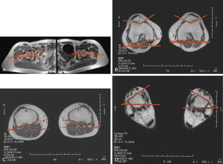 FIG 35-6, A, Axial view of the hip taken through the center of the femoral neck. B, The femoral view is taken at the proximal aspect of the femoral trochlea. C, The proximal tibia view is taken at the proximal insertion of the patellar tendon on the tubercle. The center of the patellar tendon is taken for the tibial tubercle/trochlear groove ratio. D, The axial ankle view is taken at the level of the flat edge of the talar dome (often at the same level and angle as the medial and lateral malleoli).