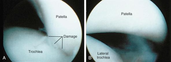 FIG 35-7, Arthroscopic medial-lateral translation manual test at 30 degrees of knee flexion shows third quadrant lateral subluxation with cartilage deterioration ( A ) and lateral subluxation viewed through the anterolateral portal ( B ).