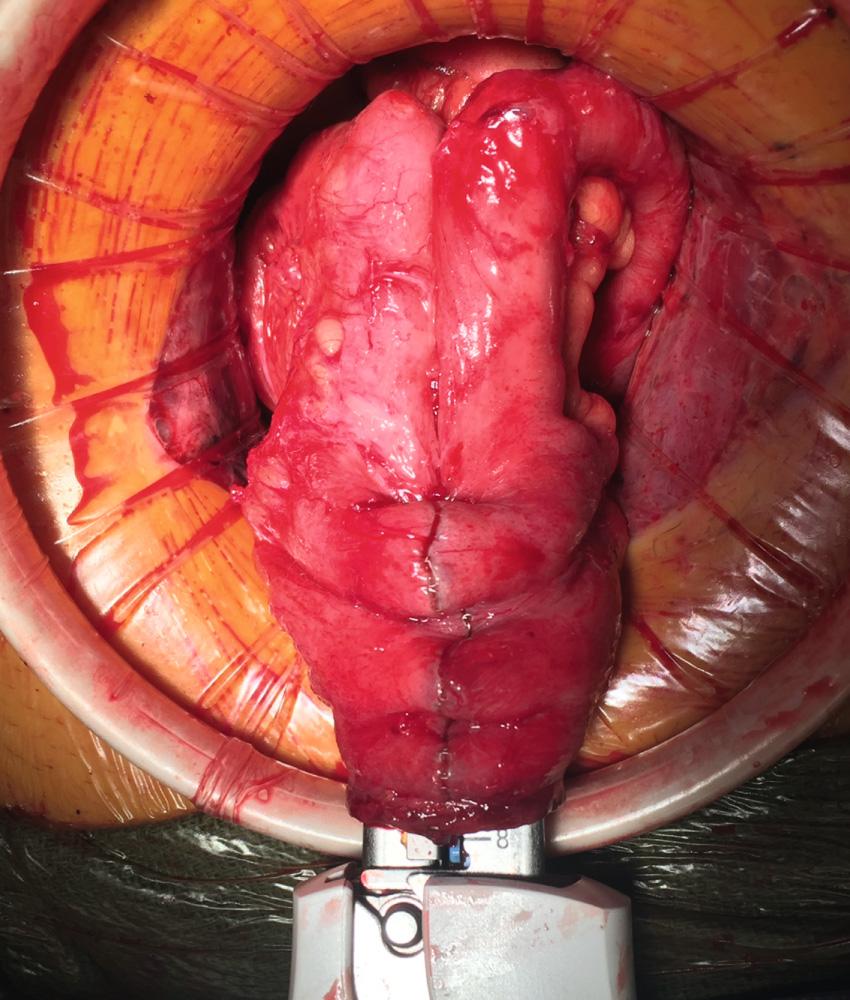 FIGURE 162.11, Construction of the ileal pouch.