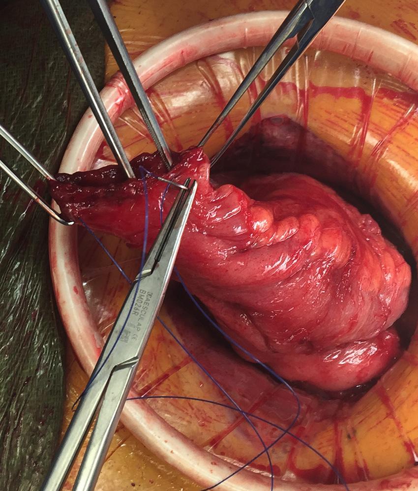 FIGURE 162.12, Purse-string suture around the common enterotomy.