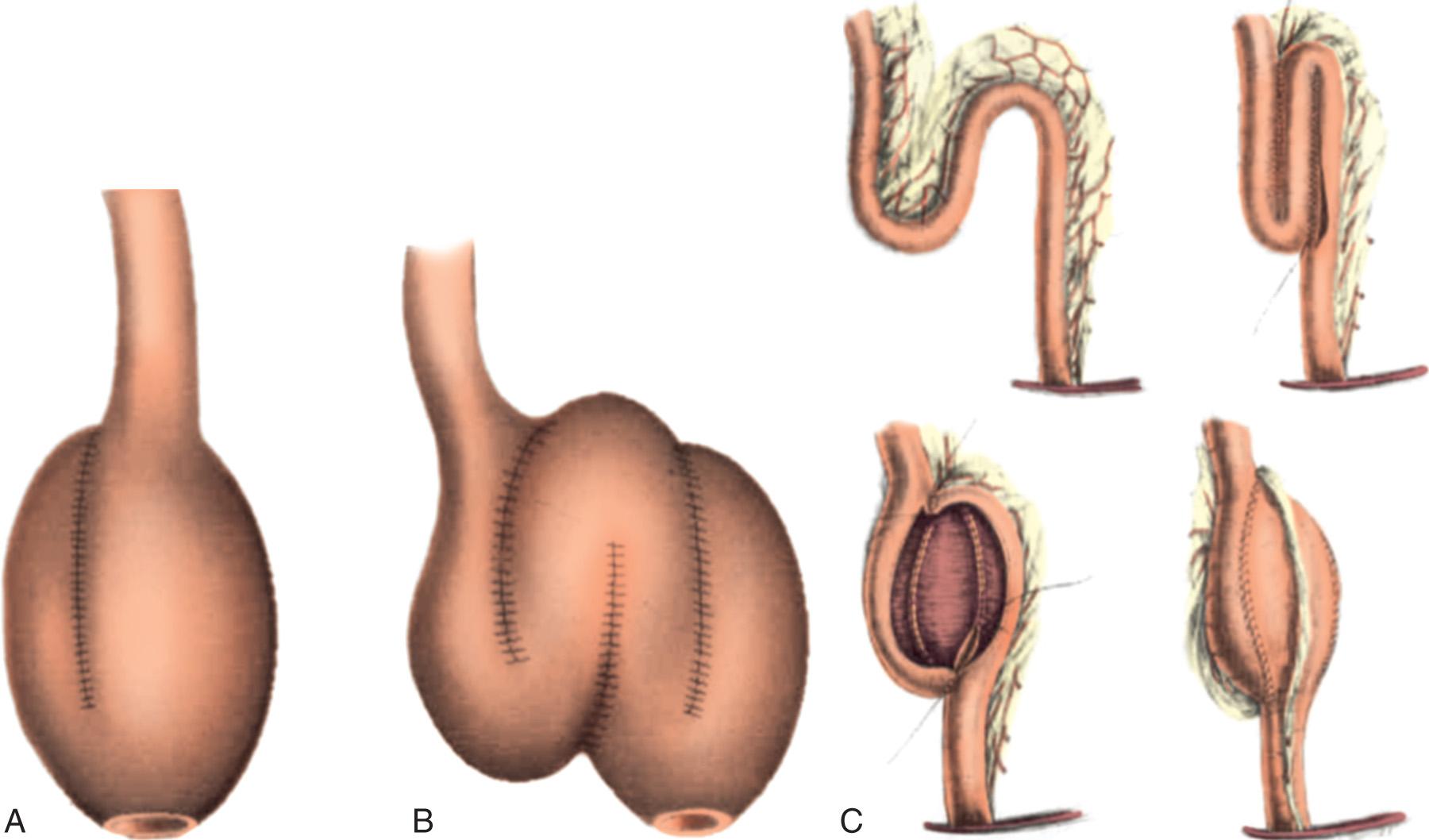 FIGURE 162.15, Ileal pouch designs. (A) J-pouch configuration; (B) W-pouch configuration; (C) S-pouch configuration.