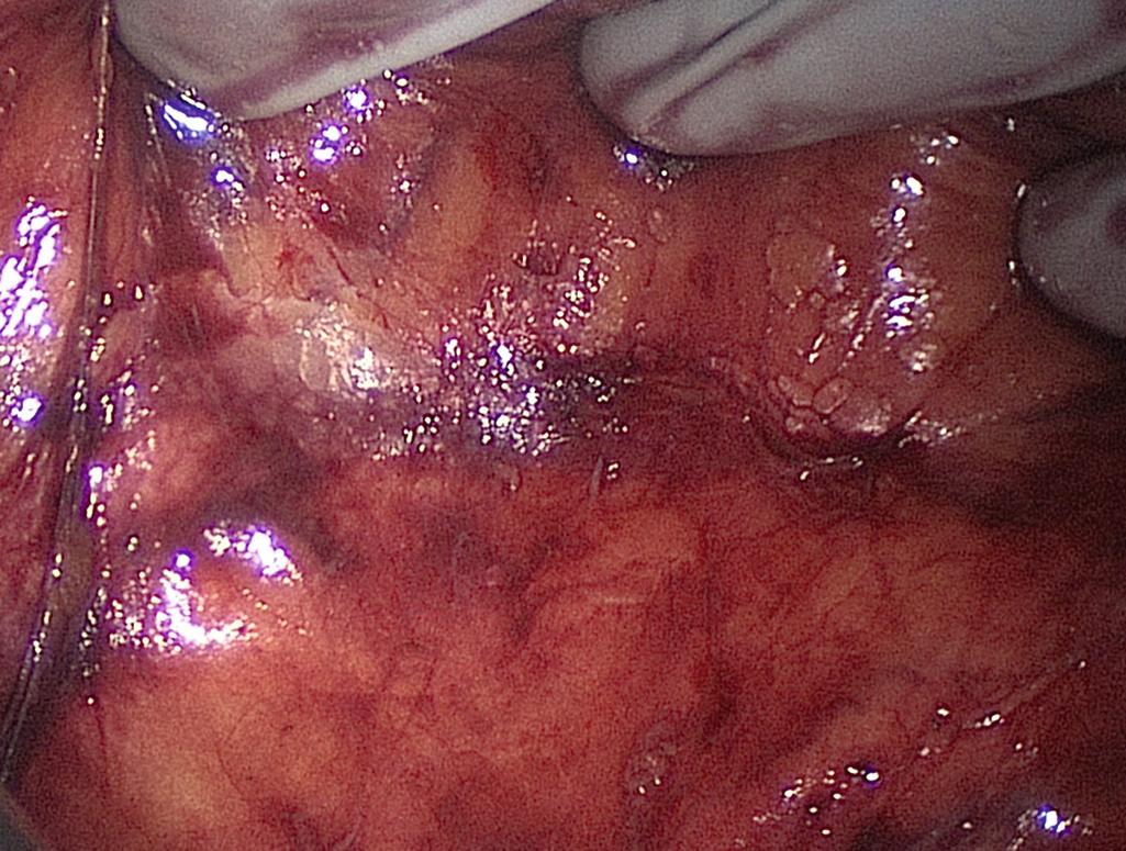 FIGURE 162.2, Dissection of the right colon mesentery off of the retroperitoneum.