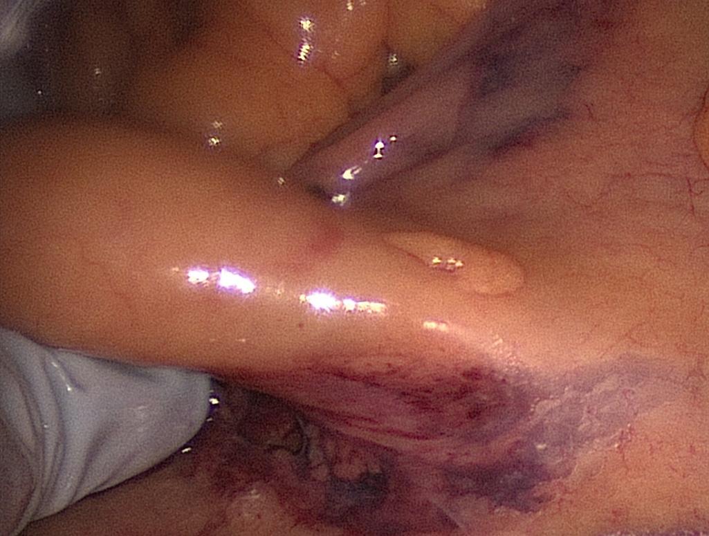 FIGURE 162.4, Identification of the ileocolic pedicle.