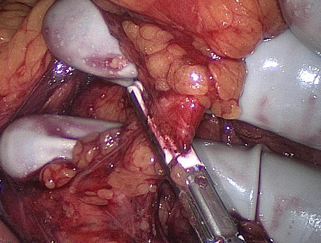 FIGURE 162.5, Ligation of the inferior mesenteric artery.