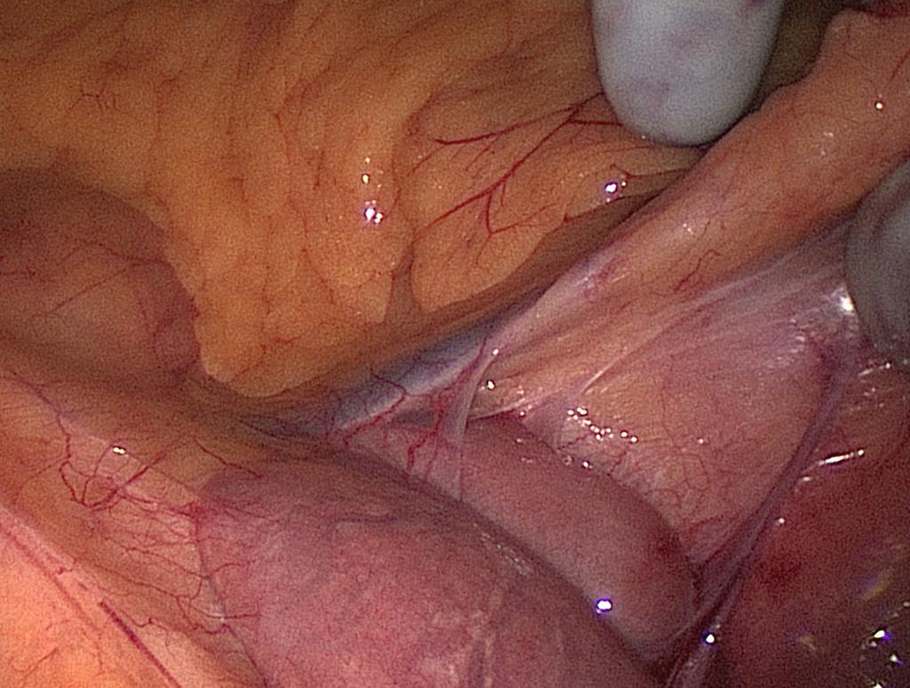 FIGURE 162.6, Identification of the inferior mesenteric vein.