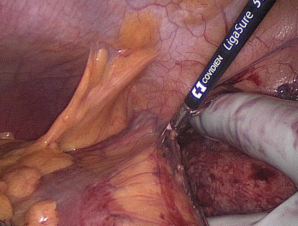 FIGURE 162.8, Division of the lateral attachments of the colon.