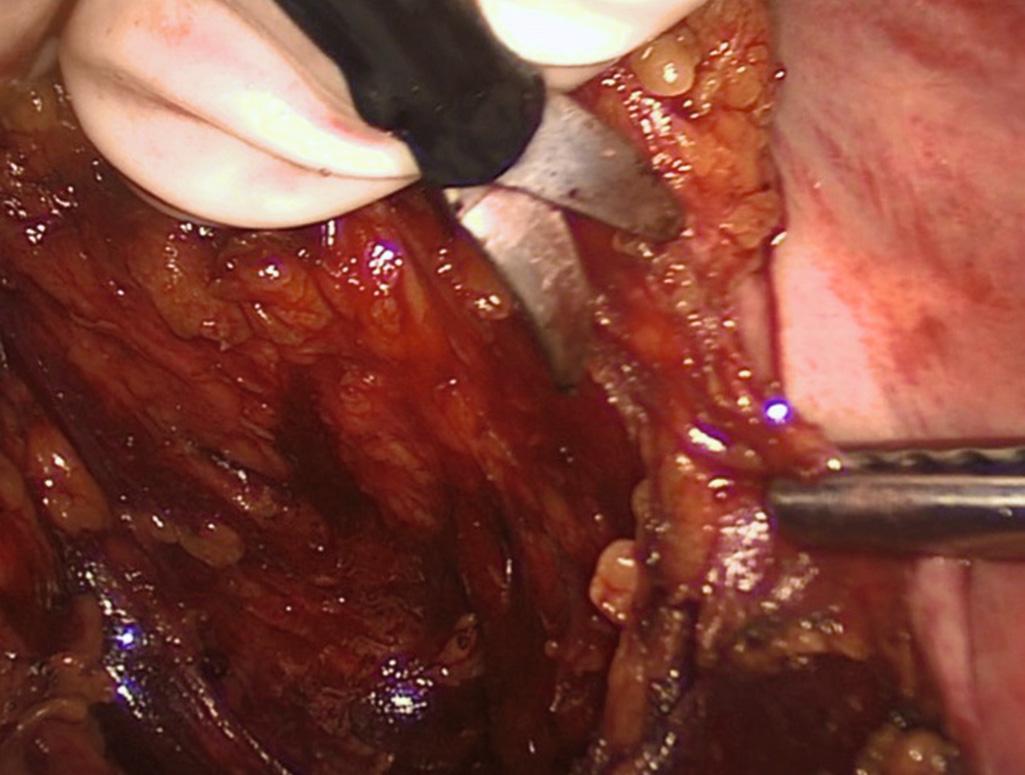 FIGURE 162.9, Hand-assisted posterior dissection.