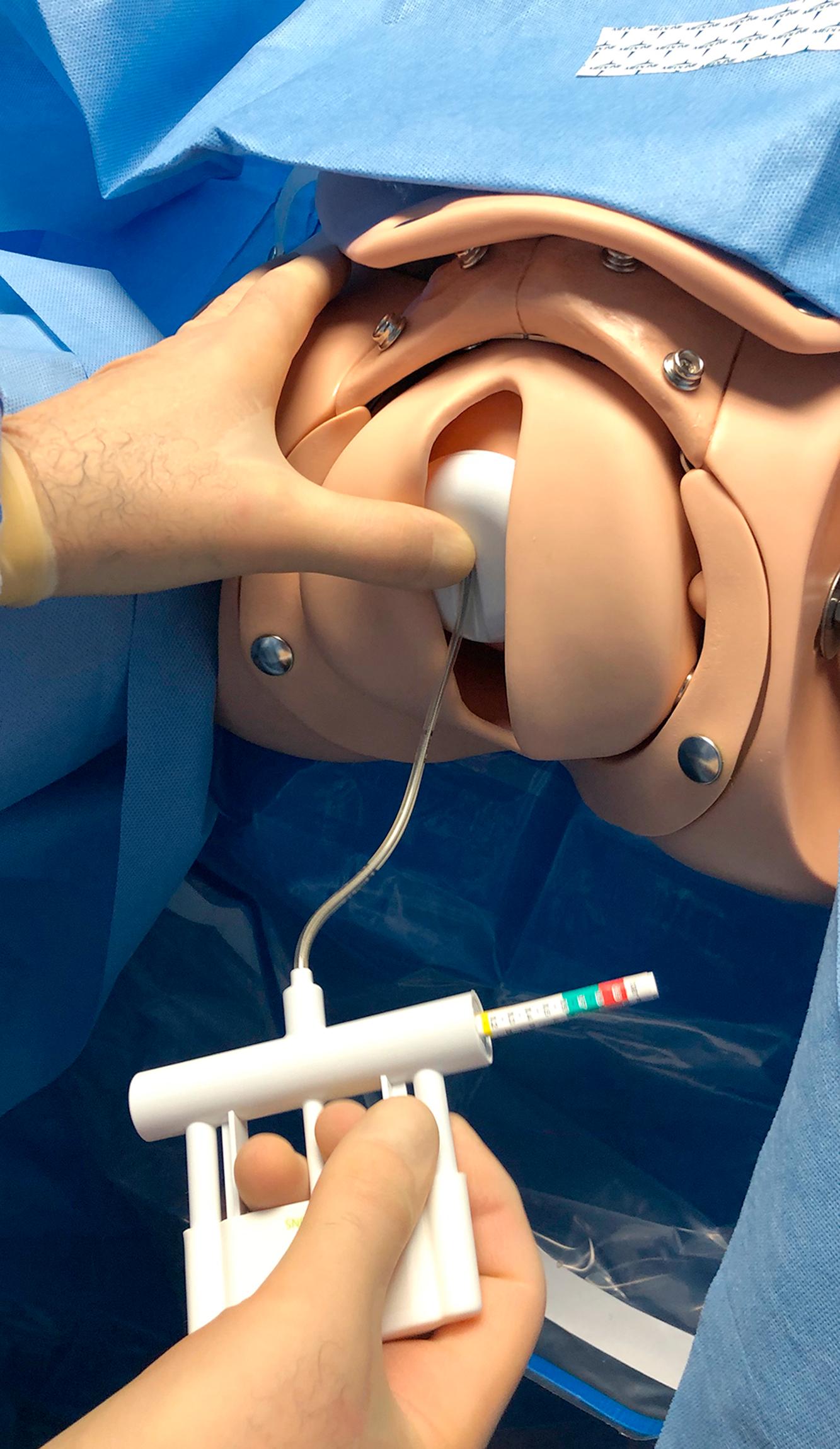 Fig. 10.3, The vacuum pressure is adjusted so the pressure is in the “green zone” as labeled by the manufacturer, typically 450–600 mmHg.