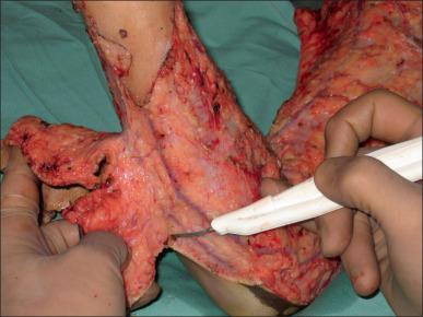 Fig. 12.2, Fascial-level excision using cutting diathermy and an incorporated smoke evacuator.