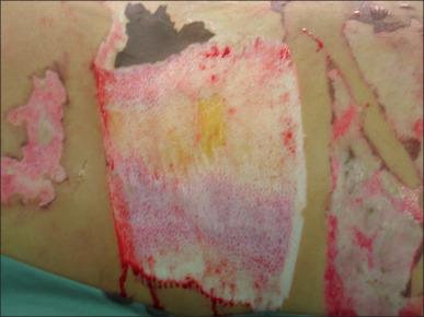 Fig. 12.4, A deep flame burn on the left thigh that is in the process of being debrided. The wound has been tumesced with 1 : 1 000 000 epinephrine in normal saline and shows minimal bleeding. The lower part of the wound demonstrates residual dead dermis with dull appearance and staining from lyzed cells. The area just above demonstrates shiny yellow, living fat and (mostly) surviving shiny white dermis with a few patches needing another slice.