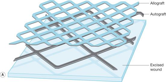 Fig. 12.7, (A) Schematic representation of “sandwich” technique of allograft overlay.