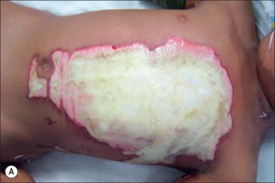 Fig. 12.8, (A–C) Deep flame burn on a boy's chest treated with early excision and Integra with VAC. (D) The silicone layer being removed on day 12 ready for thin grafting with well-vascularized dermal template underneath. (E) The pleasing final result.