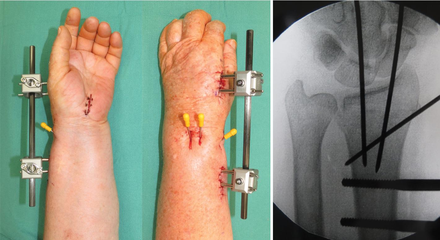 FIGURE 32.16, A single distraction rod is applied and the fracture is reduced. Anatomic alignment is verified radiographically.