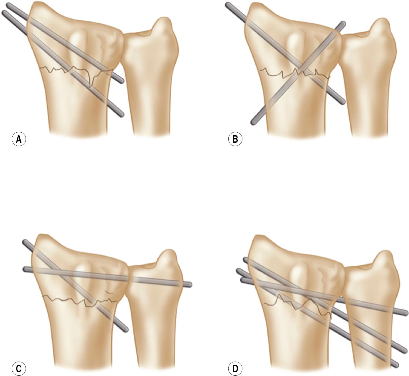 FIGURE 32.8, (A) Multiple radial styloid pins. (B) Cross radial pins. (C) Radial styloid and radial-ulnar pins, which can stabilize the distal radioulnar joint (DRUJ). (D) De Palma technique.