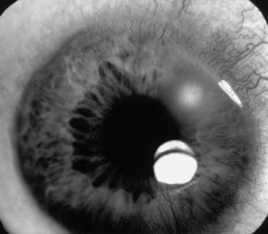 Fig. 196.1, The opacified zone overlying the iris at the 2 o’clock position is a corneal abrasion with surrounding edema. These lesions are most easily seen with fluorescein staining.