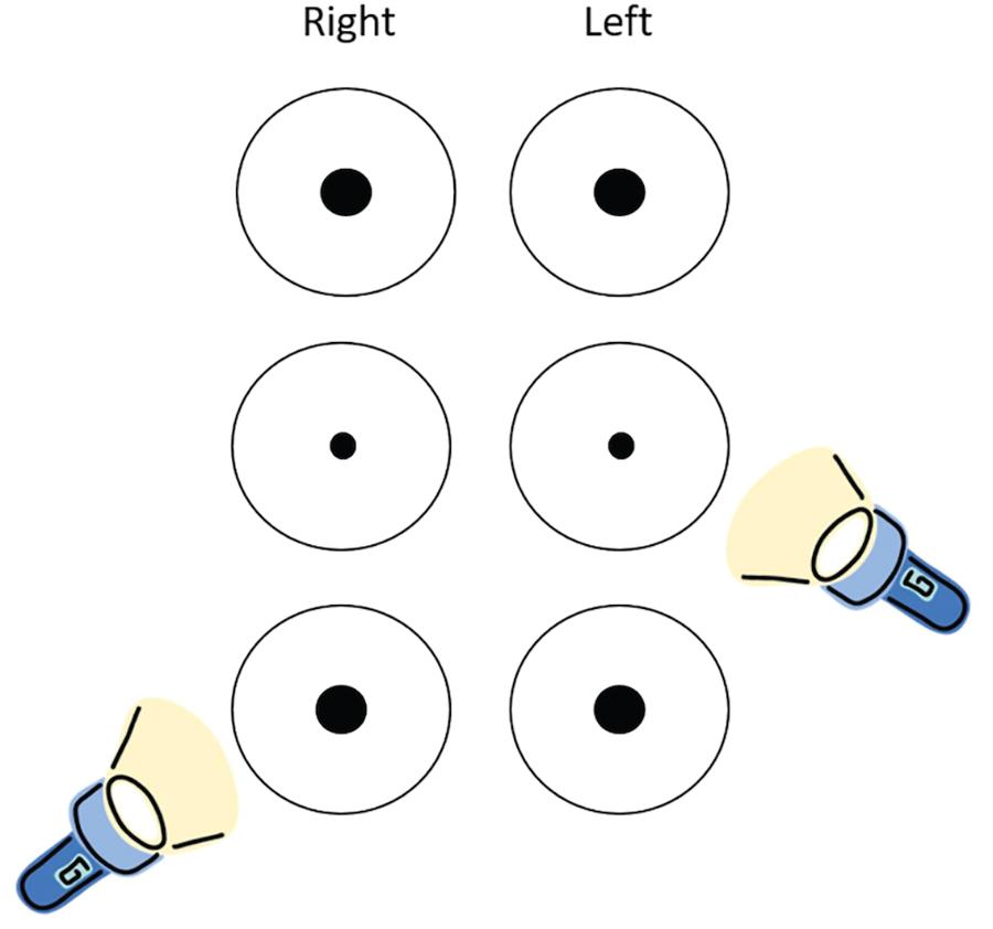 Fig. 18.1, Swinging flashlight test demonstrating right relative afferent pupillary defect (RAPD). Shining light in the contralateral eye results in constriction of both pupils. When light is moved to the contralateral eye, pupils dilates rather than constricts, indicating a right RAPD.