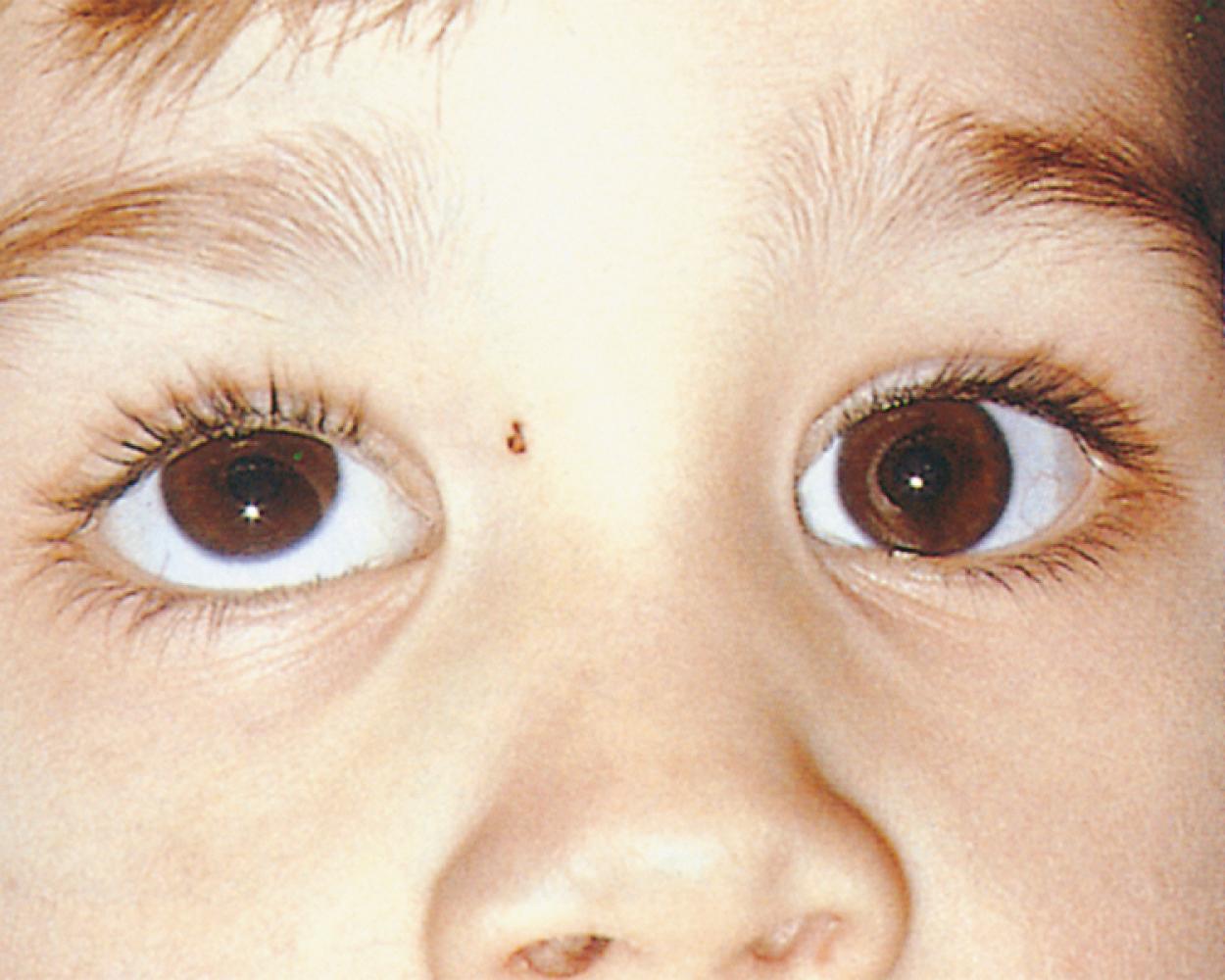 Fig. 20.13, Dissociative vertical deviation (DVD), an upward and outward drifting of the right eye. Covering the fixating left eye in the cover/uncover test causes the deviating right eye to move into alignment with the left eye. The covered left eye remains straight, and no hypo deviation or exodeviation of the left eye is seen when the cover is removed. This differentiates DVD from a tropia.