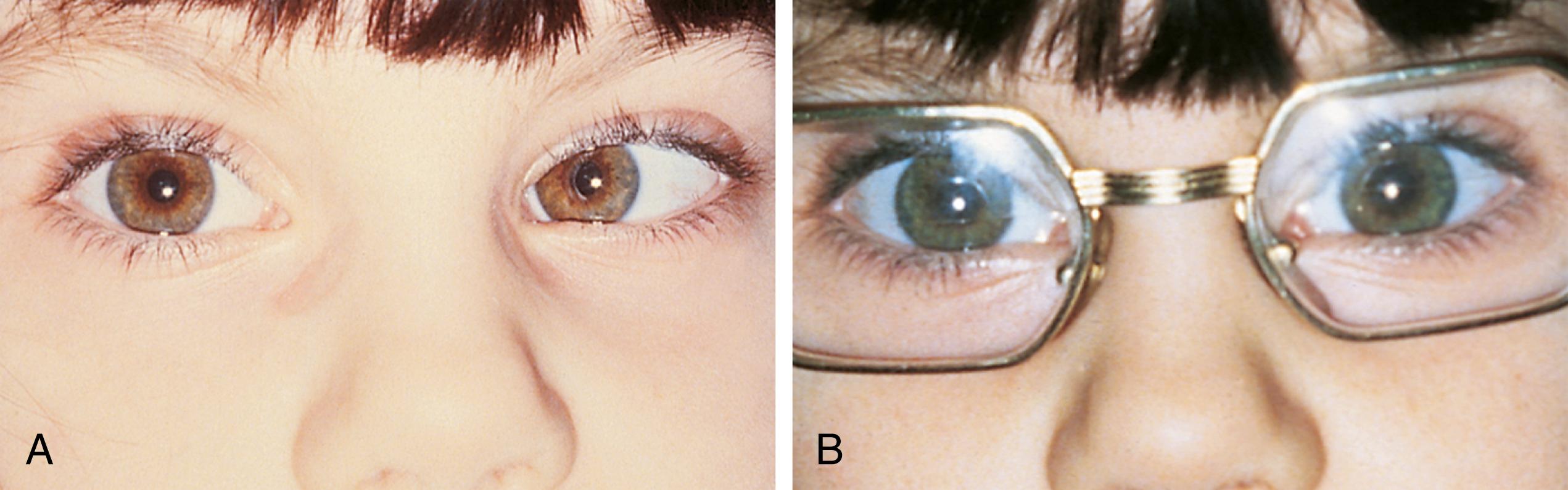 Fig. 20.14, Accommodative esotropia. (A) Esotropia. (B) Glasses have corrected the patient’s hyperopia, and the esotropic eye is now straight.