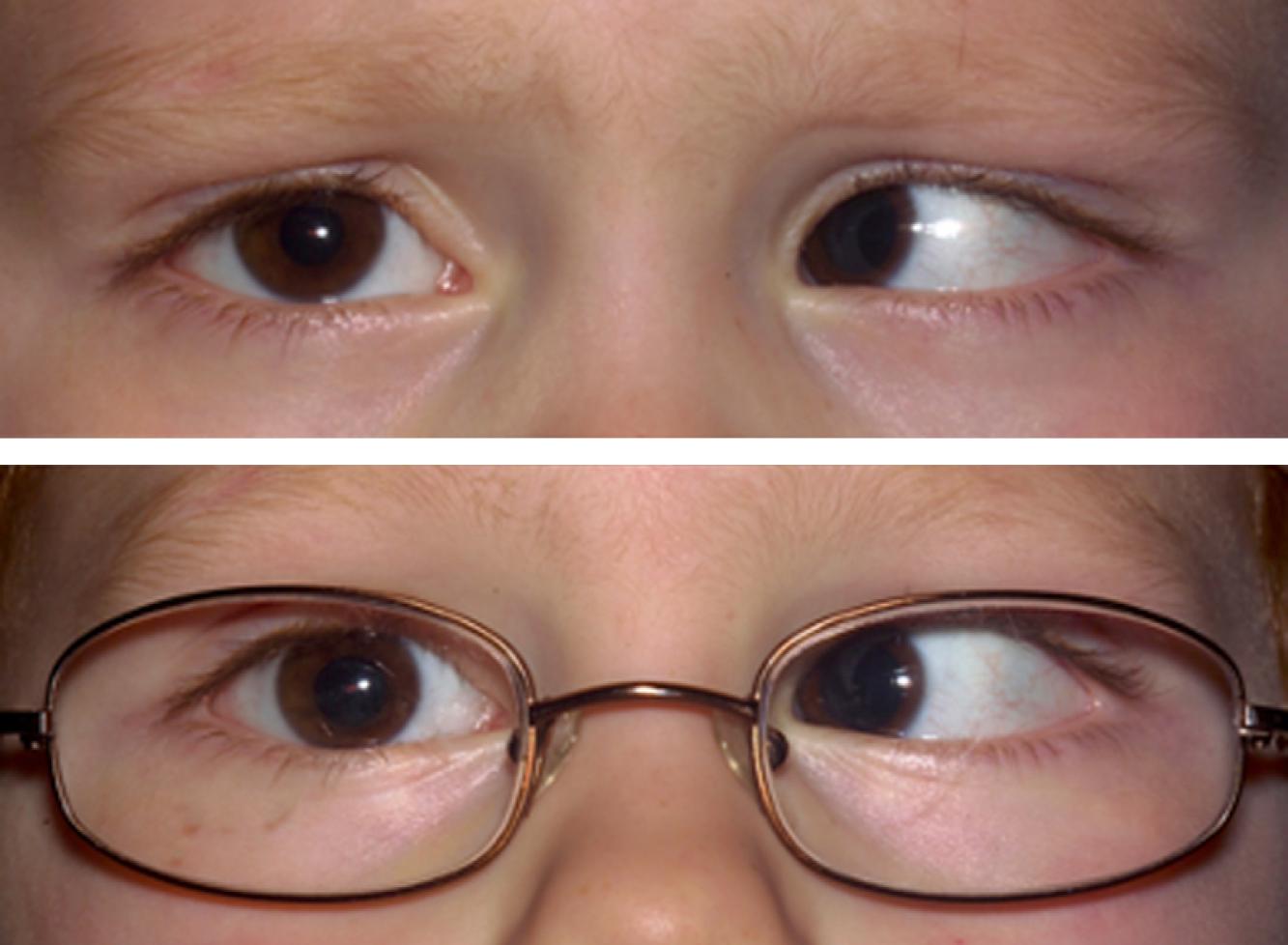 Fig. 20.16, The child has a left esotropia which does not change in magnitude with the trial of hyperopic correction. This is a non-accommodative esotropia.