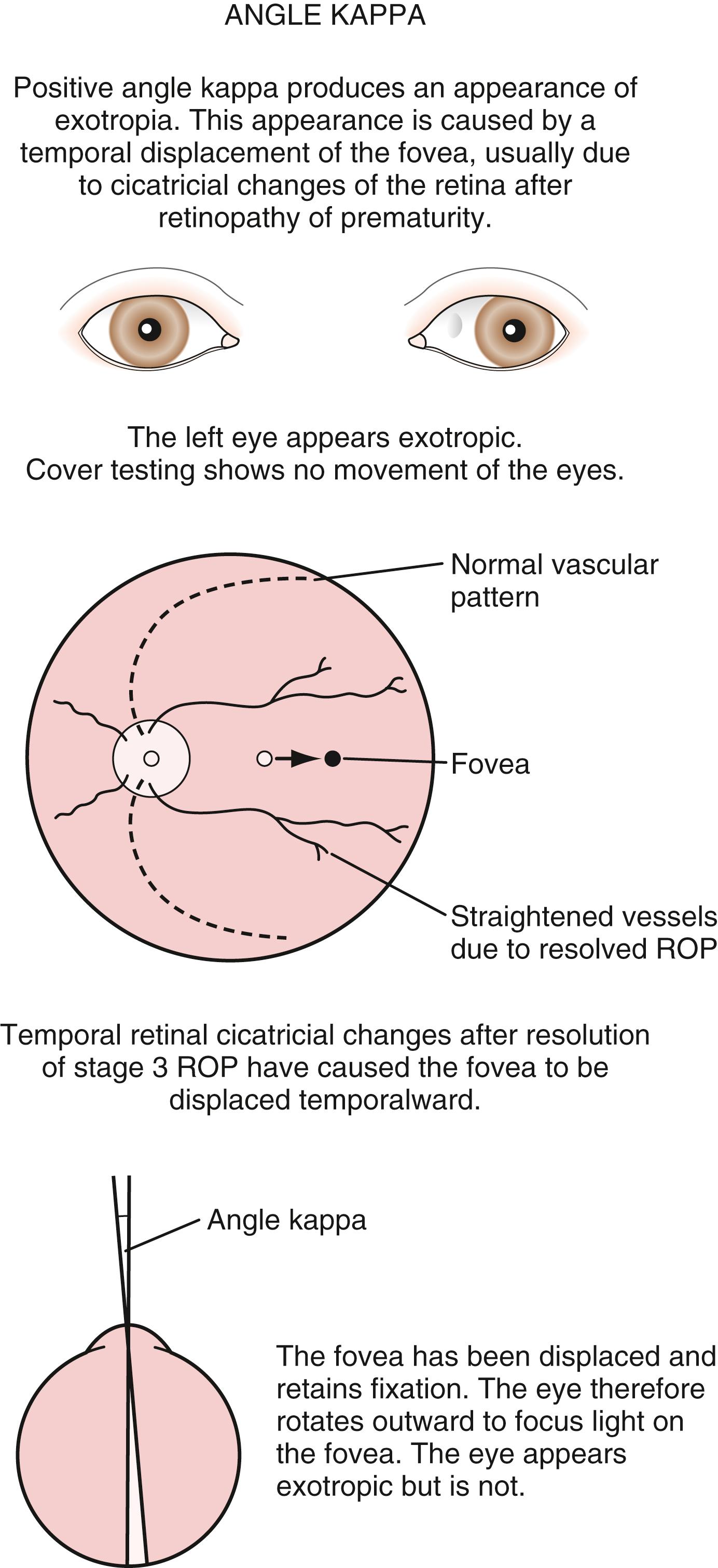 Fig. 20.21, Angle kappa. ROP, Retinopathy of prematurity.