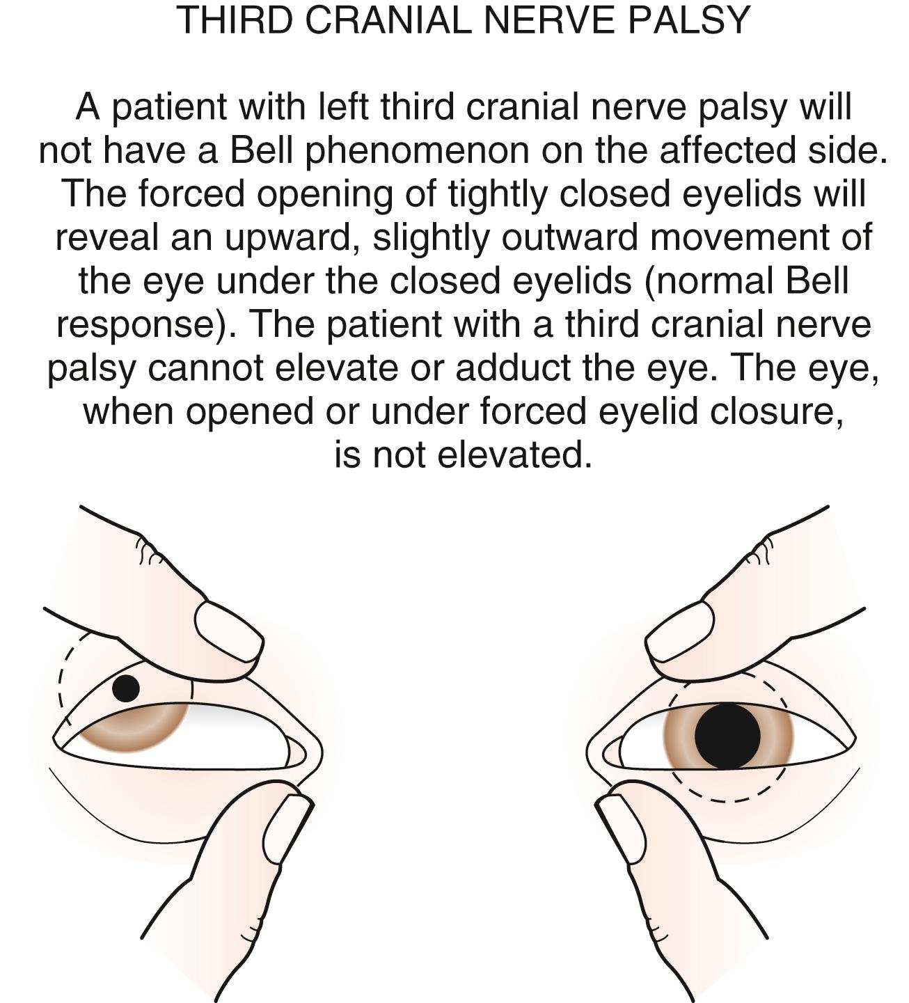 Fig. 20.23, Third cranial nerve palsy.