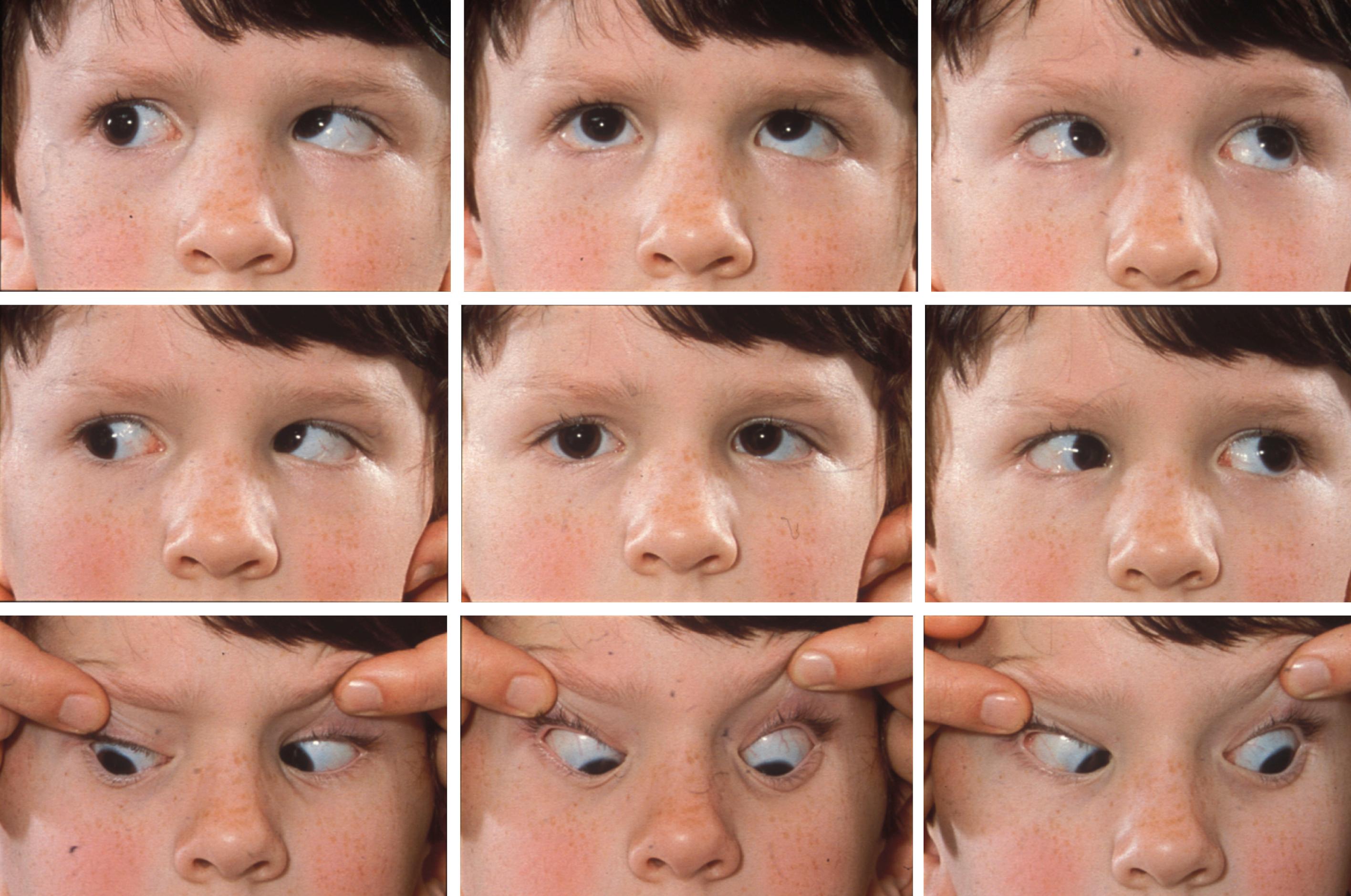 Fig. 20.24, Left fourth nerve palsy with an inability to depress the involved eye in adduction. Abnormal head posture is common with a head tilt away from the side of the fourth nerve palsy, as is overaction of the direct antagonistic inferior oblique muscle, seen as an elevation of the affected eye in adduction (gaze to the opposite side).