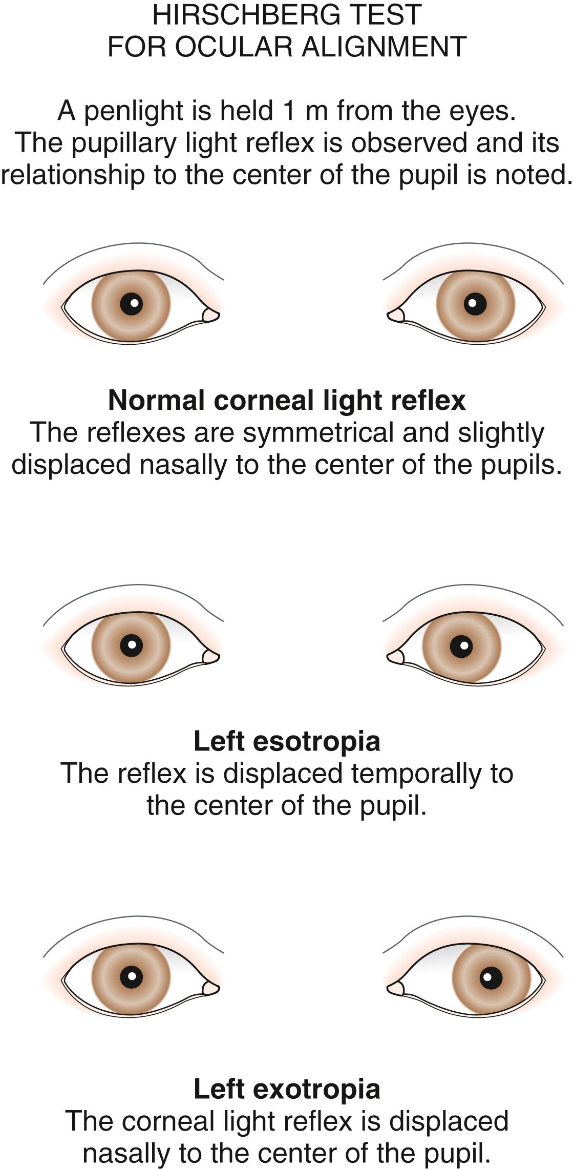 Fig. 20.27, Hirschberg test for ocular alignment.