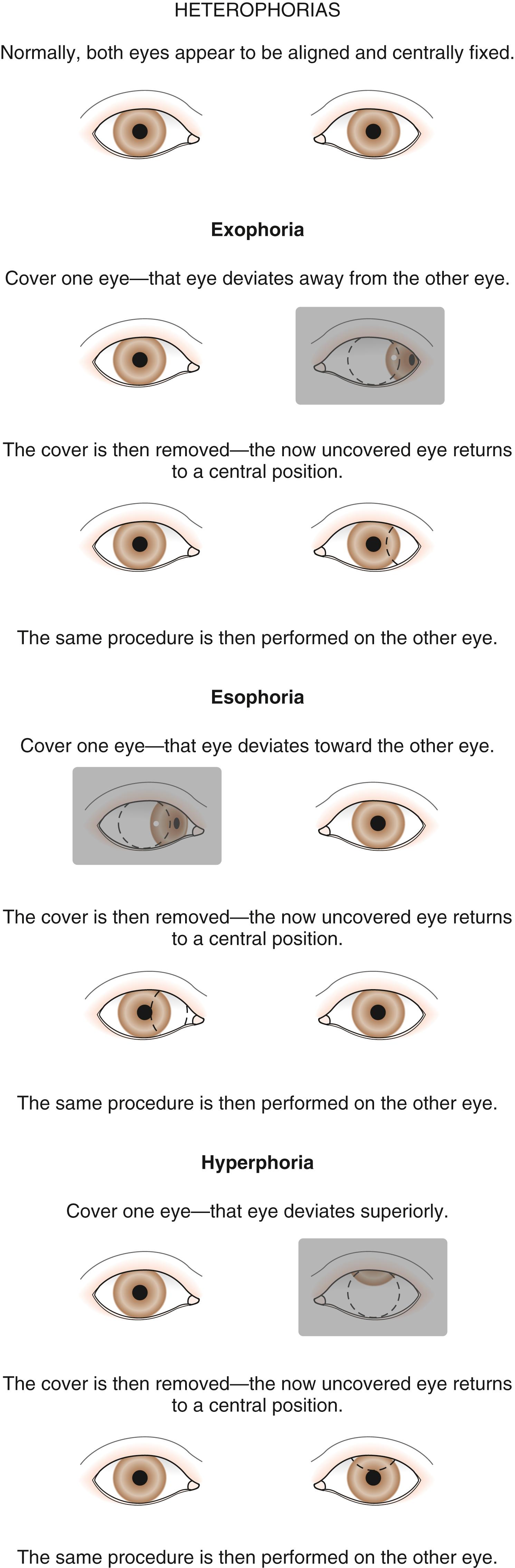 Fig. 20.28, The cover/uncover test for heterophorias.