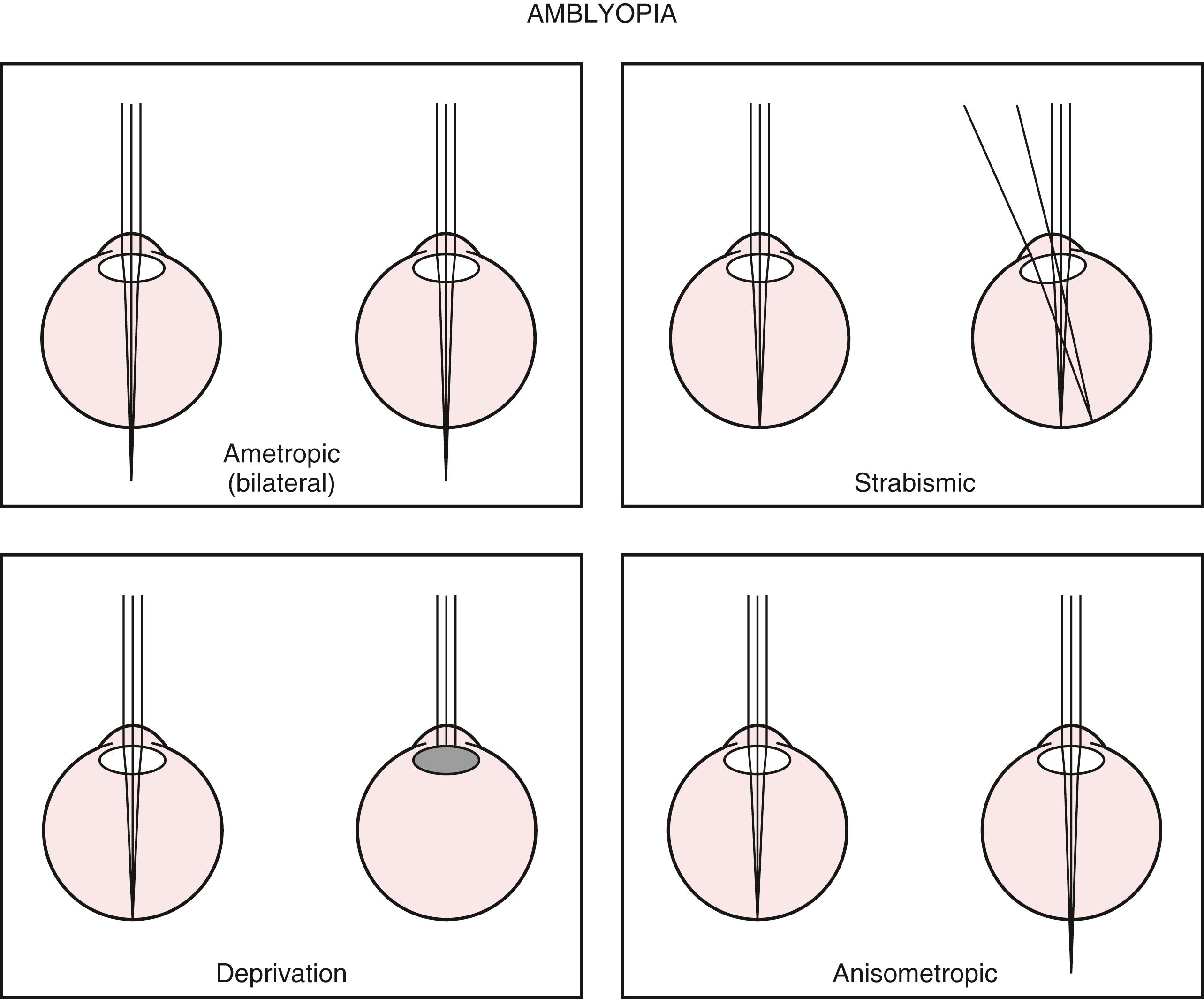 Fig. 20.30, Amblyopia is produced either by the absence of a focused retinal image (ametropic, deprivation, or anisometropic) or by suppression of a diplopic image (strabismic).