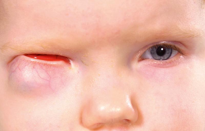 Fig. 20.32, This child has severe right microphthalmos with cyst.