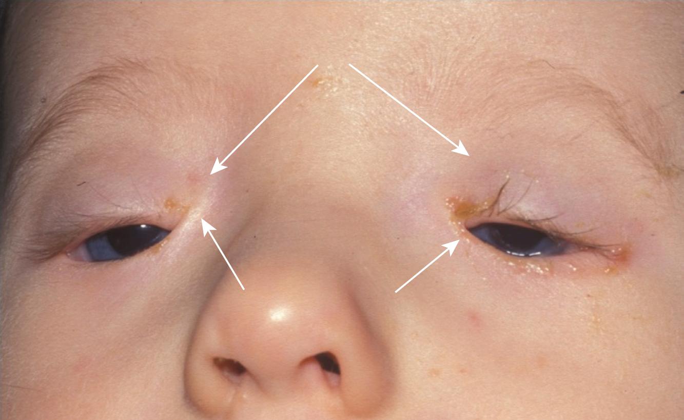 Fig. 20.35, A child with blepharophimosis syndrome (BPES) syndrome, a combination of Blepharophimosis, Ptosis, Epicanthus inversus (large white arrows) , and telecanthus (small white arrows) .