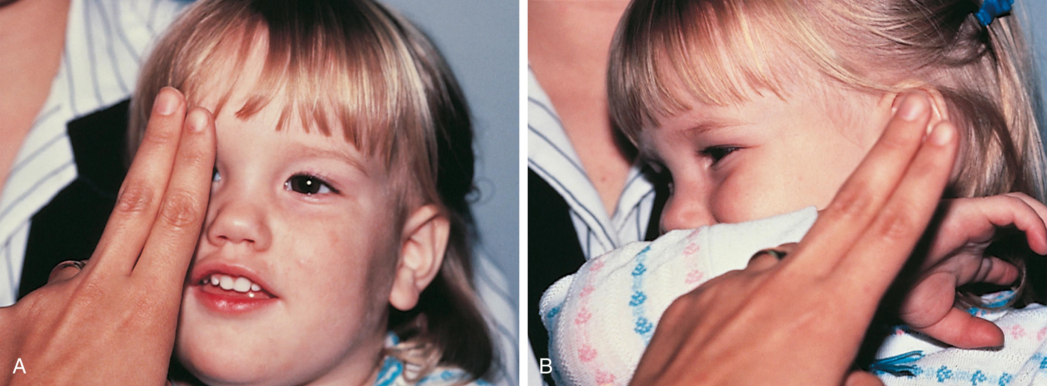 Fig. 20.4, Test for central fixation. (A) An alert child seated on her mother’s lap with one eye covered. The child is content to fix and follow with the normal left eye. (B) The cover (in this case, fingers) is then transferred to the left eye. The child becomes disturbed, pushes the hand away, and moves her head to see. This suggests that the visual acuity in the right eye is not as good as the acuity in the left eye.