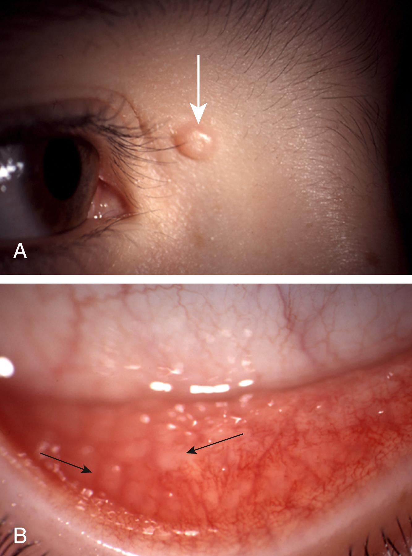 Fig. 20.48, (A) An umbilicated skin lesion which is consistent with Molluscum contagiosum (white arrow) , (B) causing a follicular conjunctivitis (follicles black arrows) .