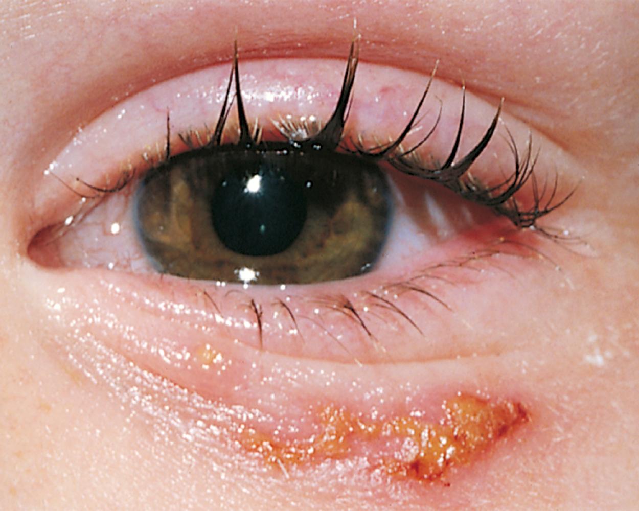 Fig. 20.51, Primary herpes simplex infection involving the periocular area. Primary infection is frequently associated with a mild diffuse keratoconjunctivitis; dendritic corneal lesions are uncommon in primary infections.