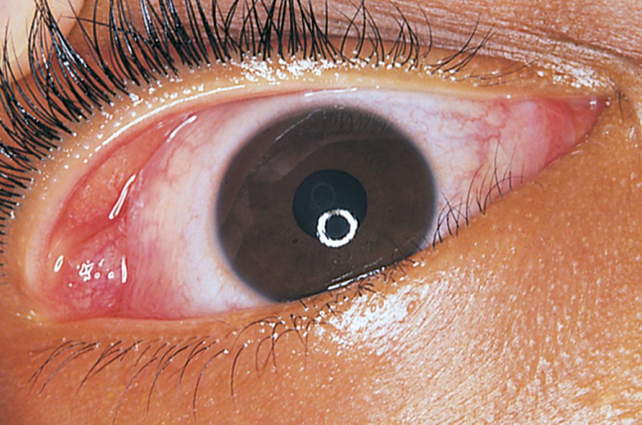 Fig. 20.53, Dacryoadenitis. The lacrimal gland has become swollen and inflamed and is visible beneath the lateral aspect of the upper eyelid. The swelling is frequently accompanied by symptoms of pain and tenderness.