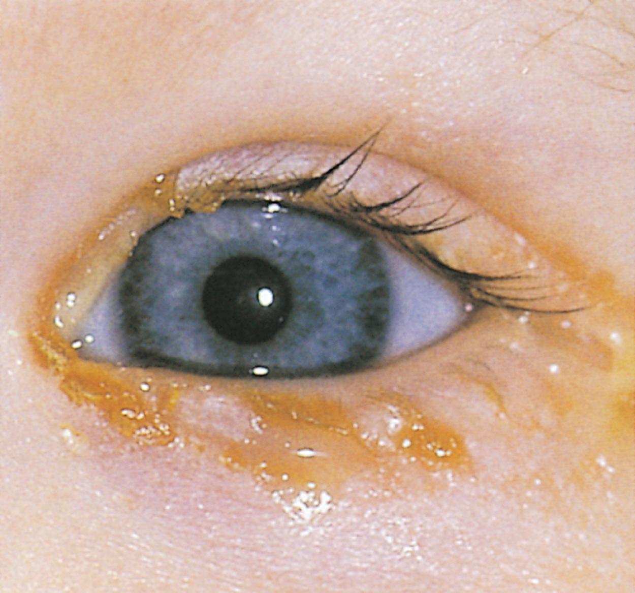 Fig. 20.54, Nasolacrimal duct obstruction. Mucopurulent discharge and tearing (epiphora) are present.