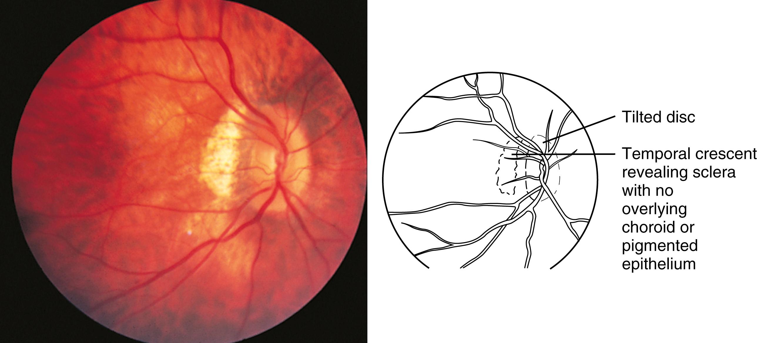 Fig. 20.10, High myopia. Thinning of the retinal pigment epithelium produces a tessellated fundus appearance. In eyes with moderate or high myopia, a temporal crescent adjacent to the optic disc is frequently present, and the optic disc may have an anomalous tilted appearance.