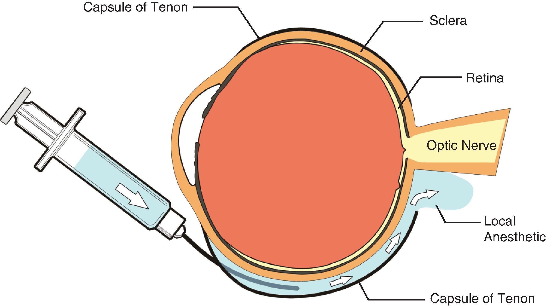 Fig. 31.2, Sub-Tenon Block. Local anesthetic is infused via a cannula into the potential space between the capsule of Tenon and the sclera, ultimately arriving at the optic nerve.