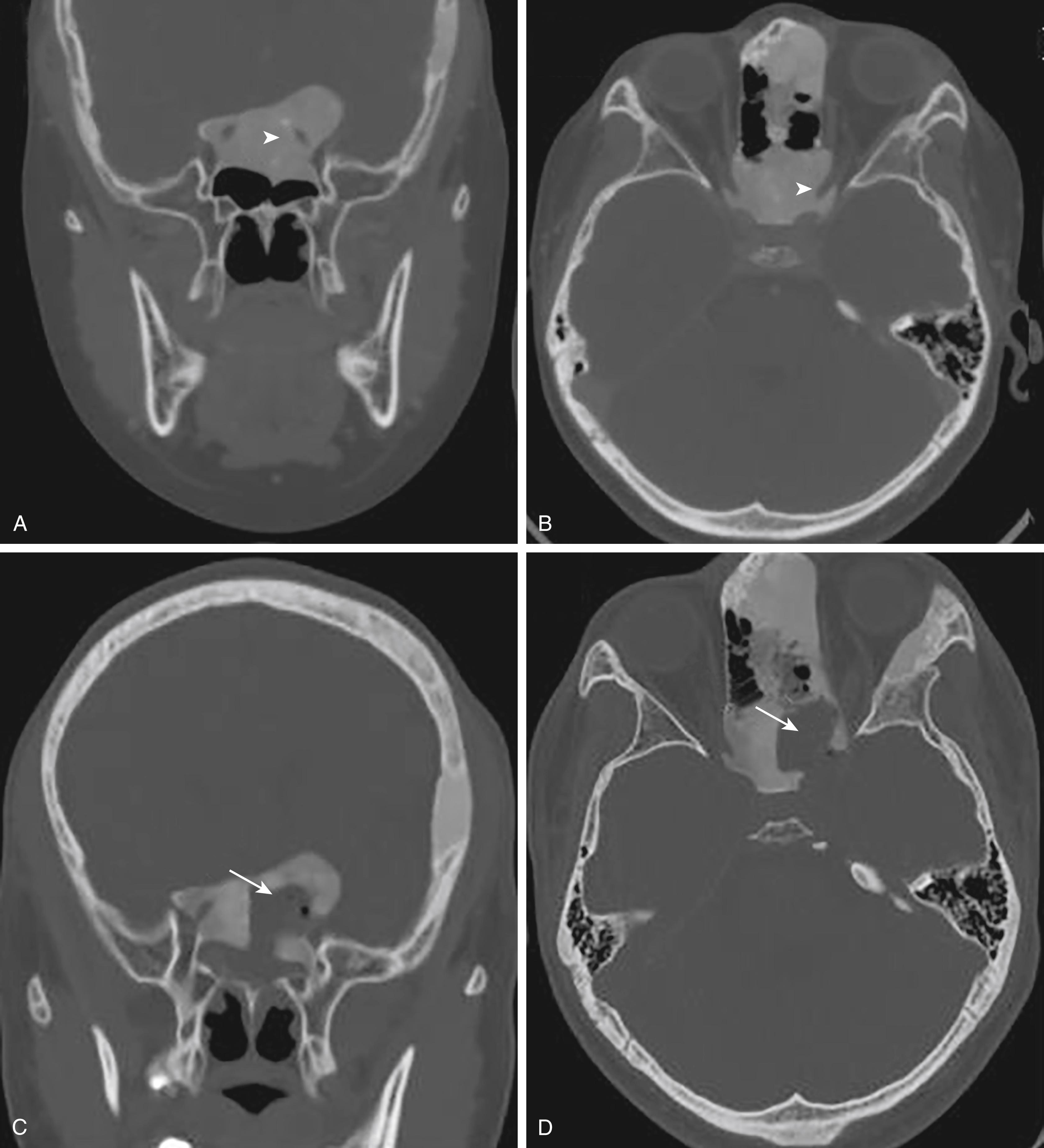 Fig. 150.1, Preoperative, A, B, and postoperative, C, D, computed tomography scans of a representative patient following endoscopic endonasal optic nerve decompression. Note symptomatic encasement of the left optic nerve (arrowheads) by fibrous dysplasia and wide bony decompression (arrows) . Right optic nerve with asymptomatic encasement (no prophylactic intervention performed).