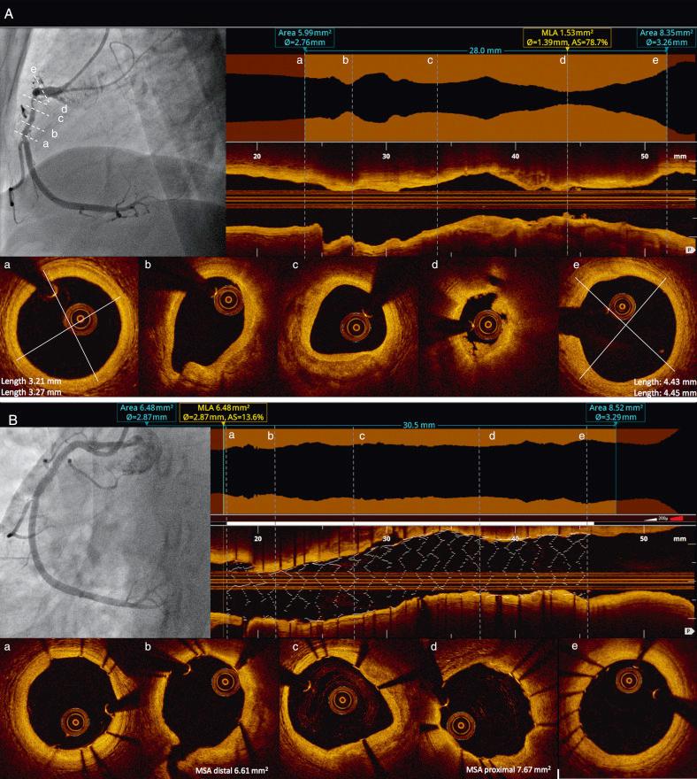 Fig. 67.1, Clinical use of optical coherence tomography (OCT) for stent optimization.