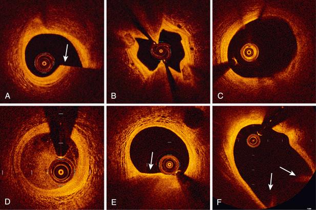 Fig. 67.2, Artifacts with optical coherence tomography.