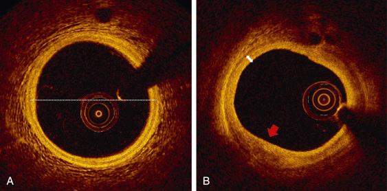 Fig. 67.3, Normal Coronary artery and early plaques in optical coherence tomography.