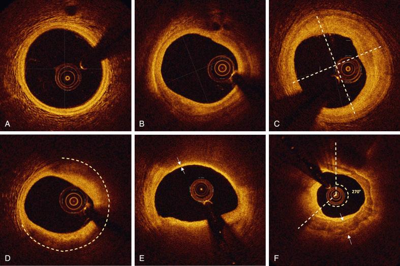 Fig. 67.4, Coronary plaque detection in optical coherence tomography.