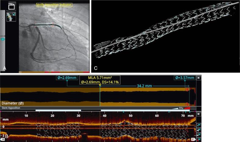 Fig. 67.7, New stent rendering system.