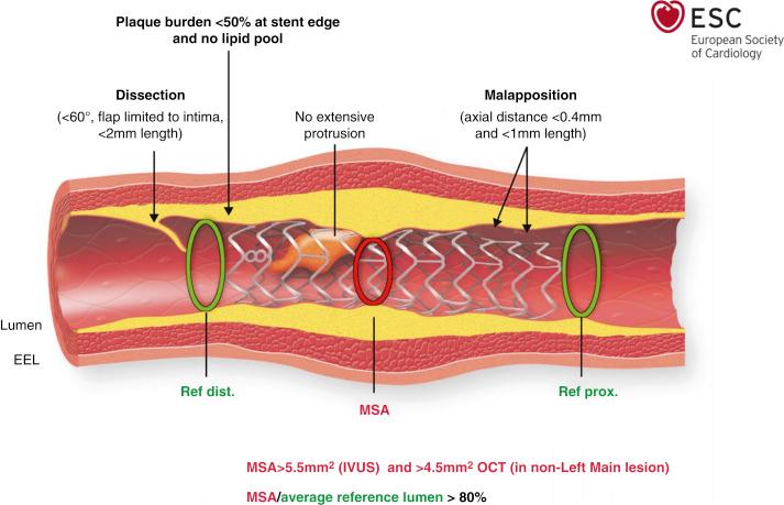 Fig. 67.8, Summary of postpercutaneous coronary intervention optimization targets for intravascular ultrasound (IVUS) and optical coherence tomography (OCT) .