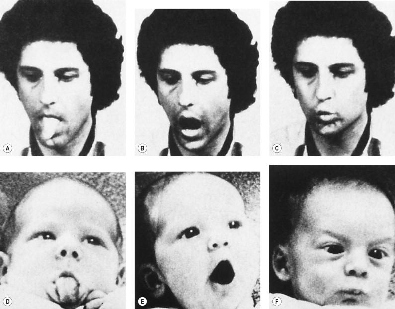 Figure 1.4, This photo shows a recently born infant mimicking the expression of psychologist Dr. A Meltzoff. The baby is obviously able to perceive the different expressions in order to mimic them.