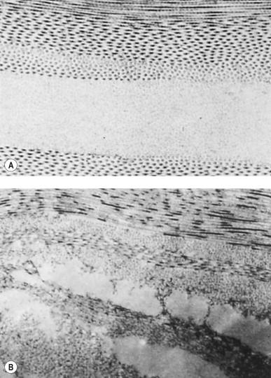 Figure 1.6, ( A ) Electron micrograph showing the neat pattern of corneal collagen fibers. The black dots are the fibers cut on end. In this photo the spacing between fibers is less than a wavelength of light apart. ( B ) Large spaces between collagen fibers, as seen in a waterlogged, hazy cornea.