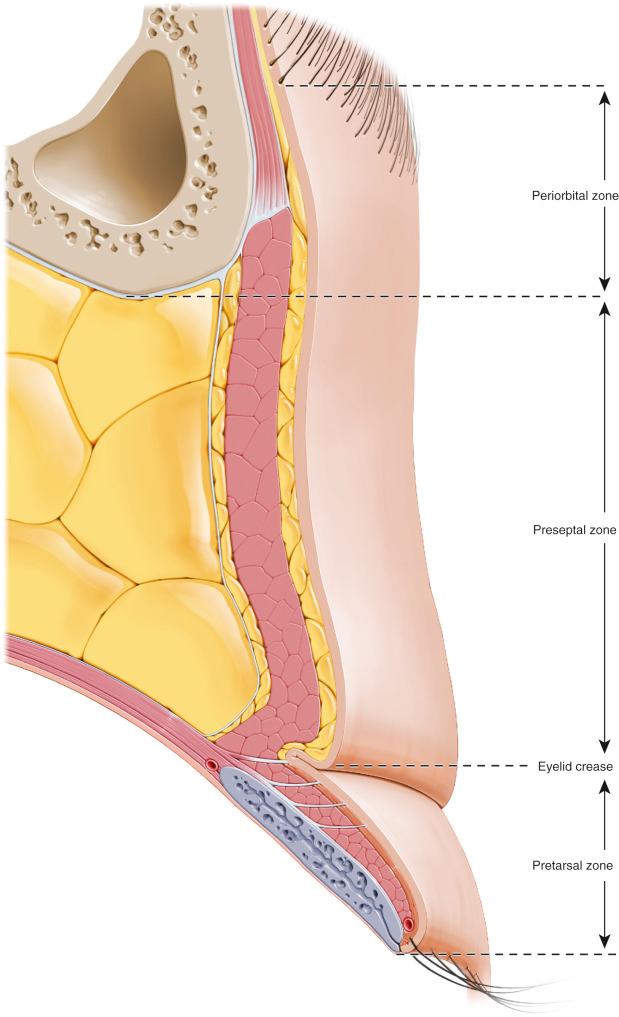 FIGURE 12-2, The upper eyelid and crease can be thought of conceptually as consisting of three zones: the eyelid crease (which acts as the junctional zone or the telescoping pivot), the pretarsal zone below it and the preseptal zone above it.